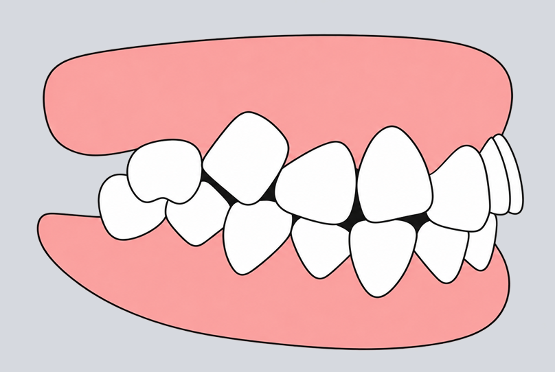 Crooked teeth