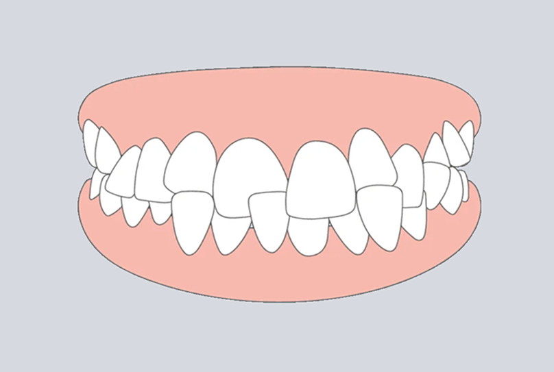 Cross-bite