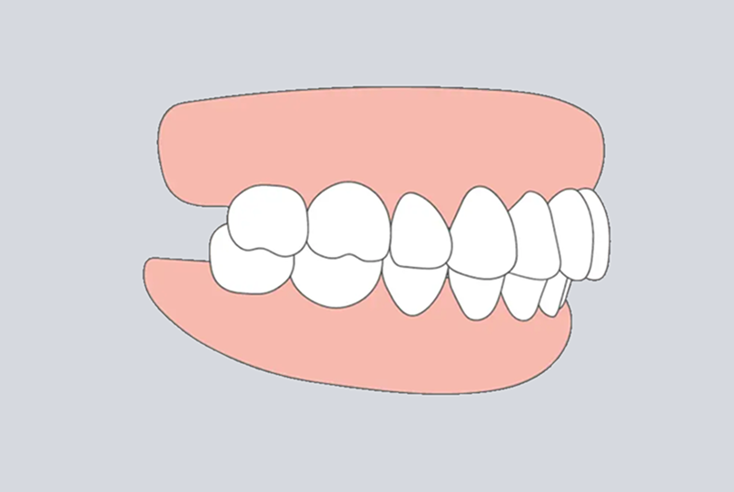 Deep bite