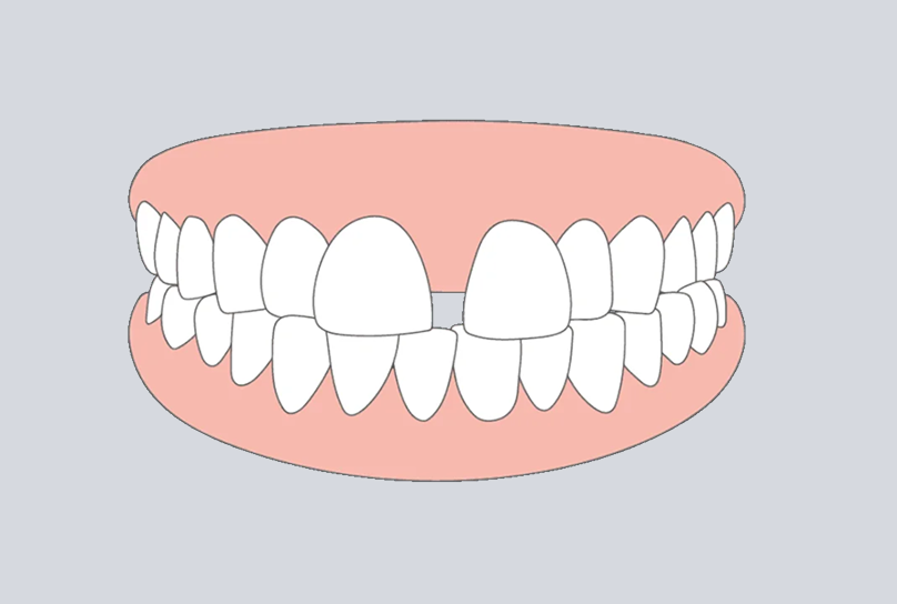 Teeth gap