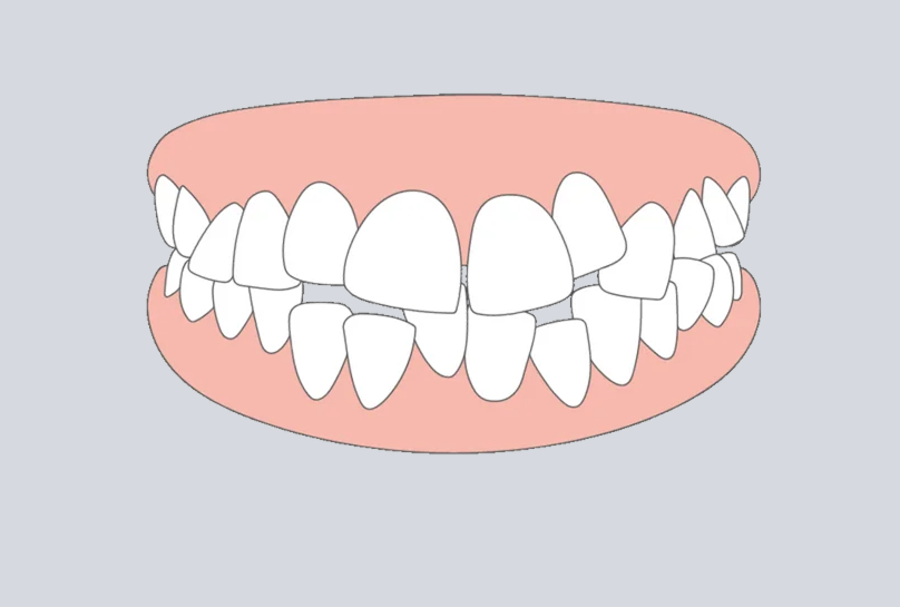 Teeth crowding